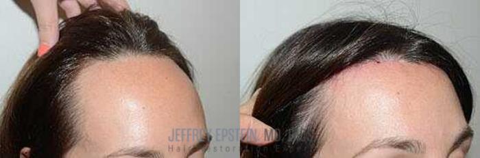 Before & After Hair Transplants For Women Case 173 View 1 View in Miami, FL