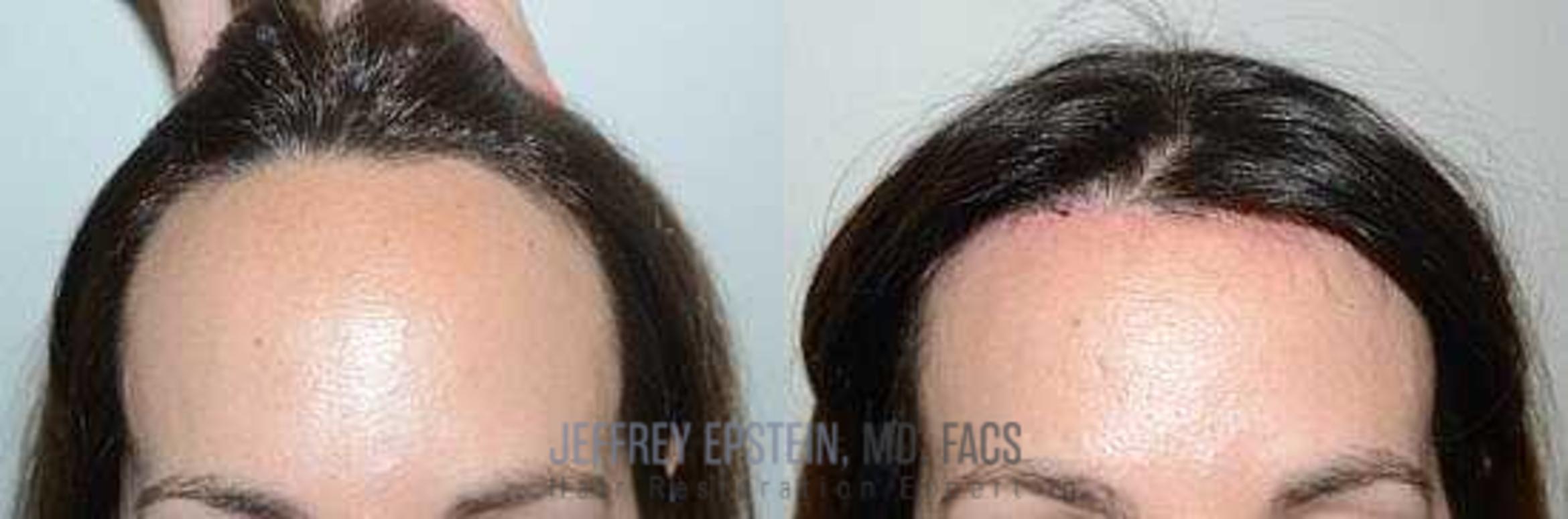 Before & After Hair Transplants For Women Case 173 View 2 View in Miami, FL