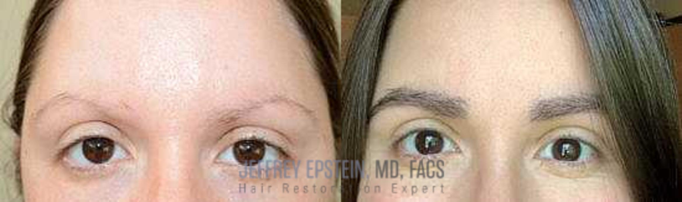 Before & After Hair Transplants For Women Case 174 View 2 View in Miami, FL