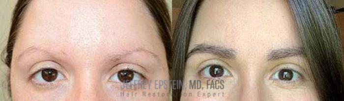Before & After Hair Transplants For Women Case 174 View 2 View in Miami, FL