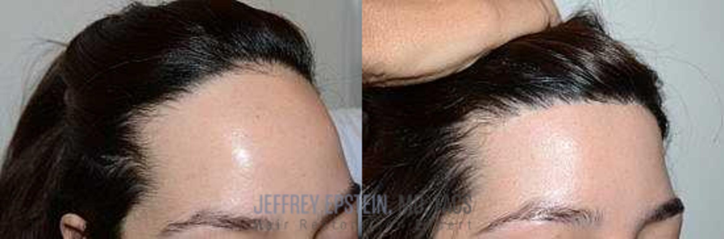 Before & After Hair Transplants For Women Case 175 View 2 View in Miami, FL