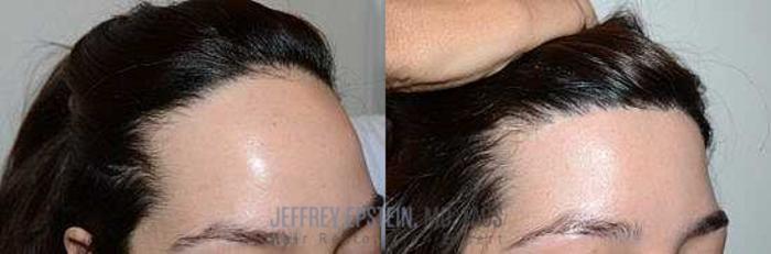 Before & After Hair Transplants For Women Case 175 View 2 View in Miami, FL