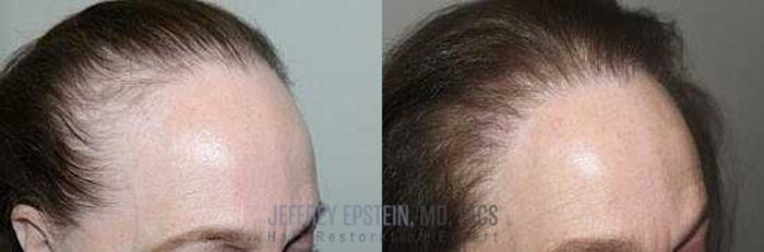 Before & After Hair Transplants For Women Case 176 View 1 View in Miami, FL