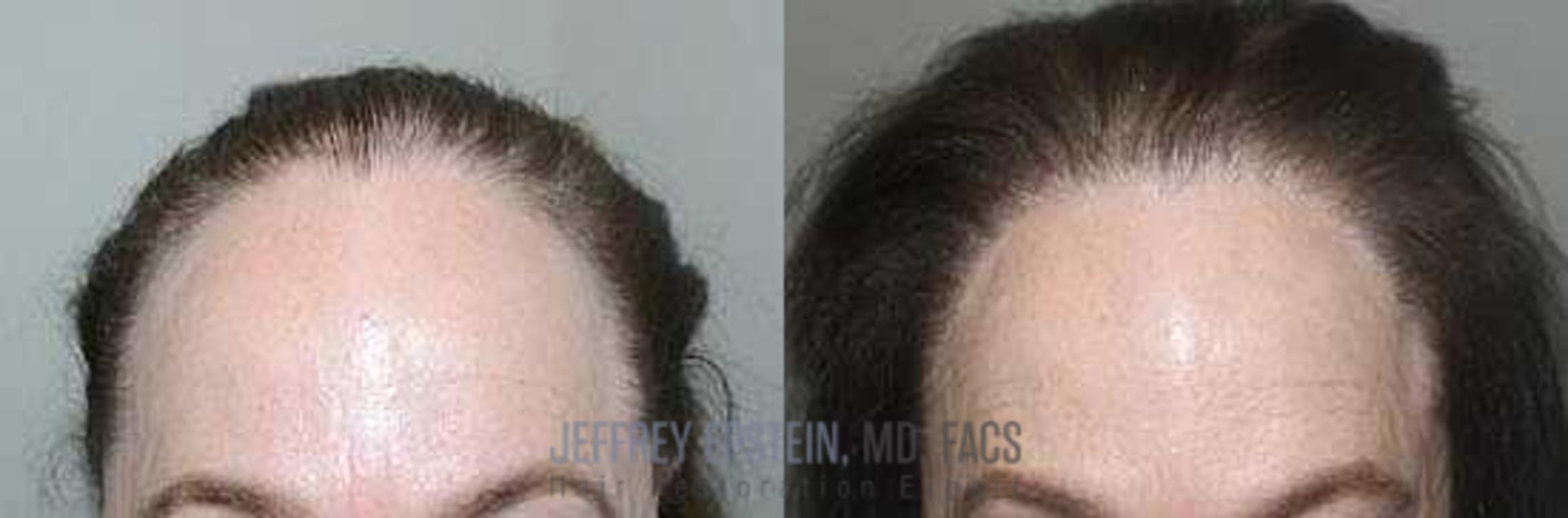 Before & After Hair Transplants For Women Case 176 View 2 View in Miami, FL