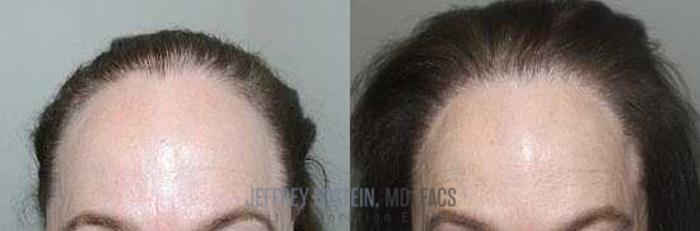 Before & After Hair Transplants For Women Case 176 View 2 View in Miami, FL