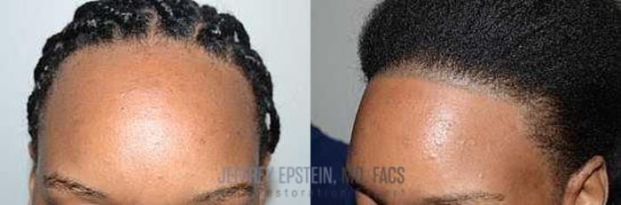 Before & After Hair Transplants For Women Case 178 View 3 View in Miami, FL