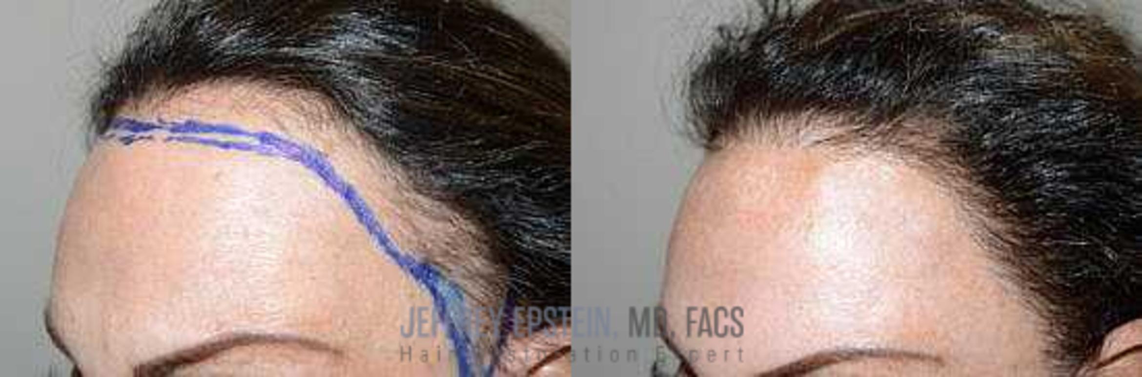 Before & After Hair Transplants For Women Case 179 View 1 View in Miami, FL