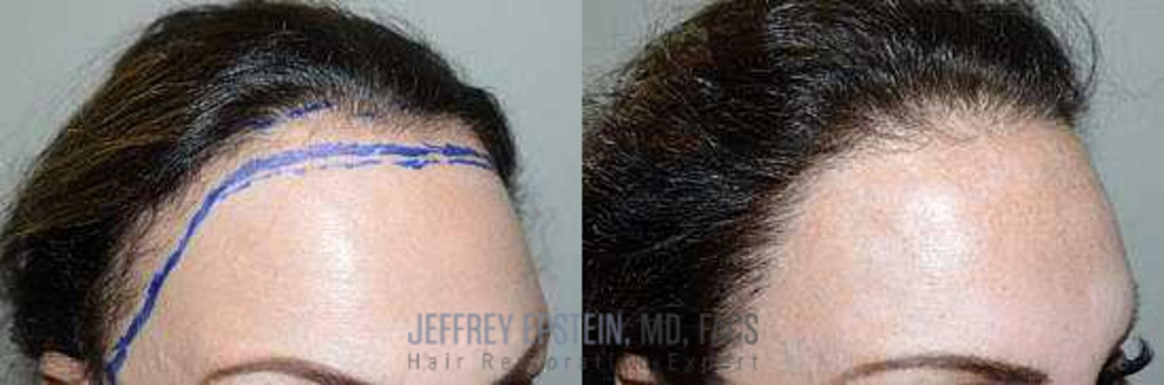 Before & After Hair Transplants For Women Case 179 View 2 View in Miami, FL