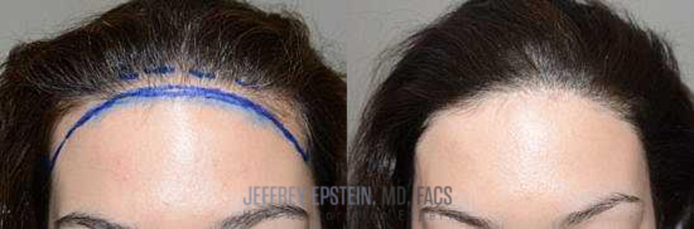 Before & After Hair Transplants For Women Case 180 View 1 View in Miami, FL