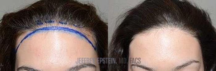 Before & After Hair Transplants For Women Case 180 View 1 View in Miami, FL