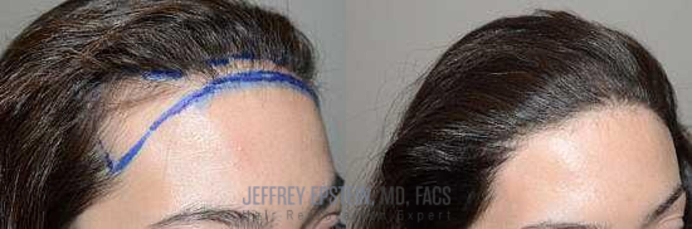 Before & After Hair Transplants For Women Case 180 View 2 View in Miami, FL