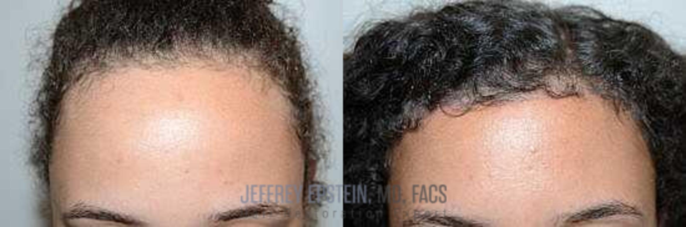 Before & After Hair Transplants For Women Case 181 View 2 View in Miami, FL