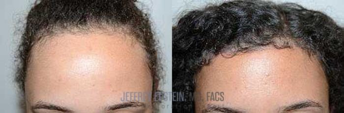 Before & After Hair Transplants For Women Case 181 View 2 View in Miami, FL
