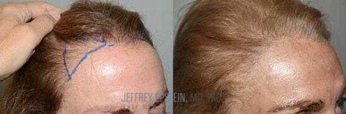 Before & After Hair Transplants For Women Case 182 View 2 View in Miami, FL