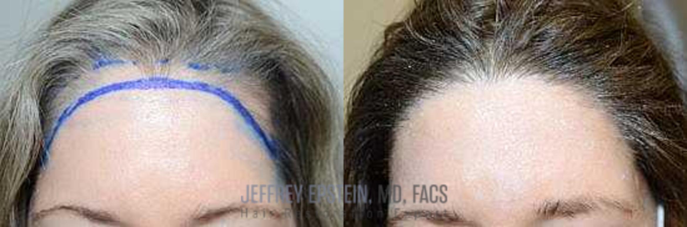 Before & After Hair Transplants For Women Case 183 View 1 View in Miami, FL