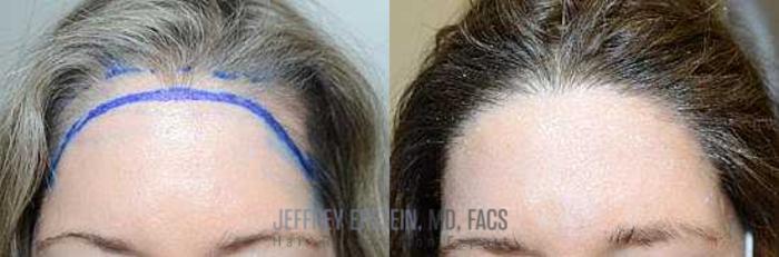 Before & After Hair Transplants For Women Case 183 View 1 View in Miami, FL