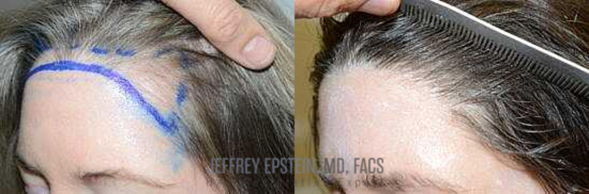 Before & After Hair Transplants For Women Case 183 View 2 View in Miami, FL