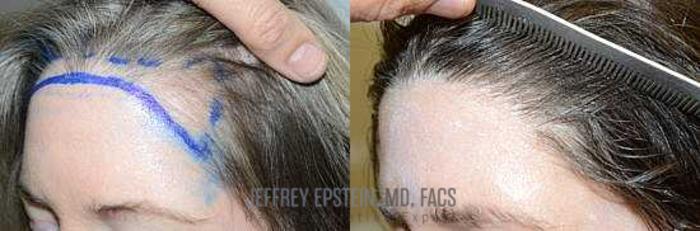 Before & After Hair Transplants For Women Case 183 View 2 View in Miami, FL
