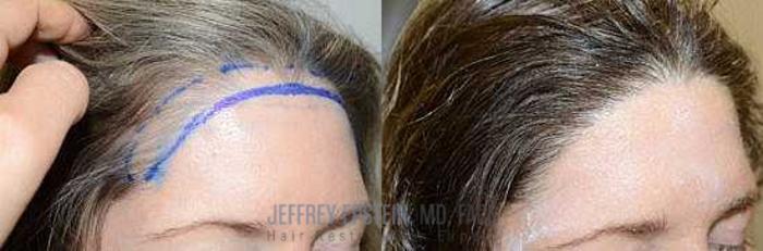 Before & After Hair Transplants For Women Case 183 View 3 View in Miami, FL