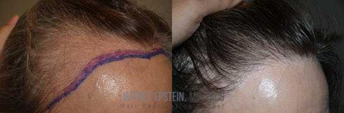 Before & After Hair Transplants For Women Case 184 View 1 View in Miami, FL