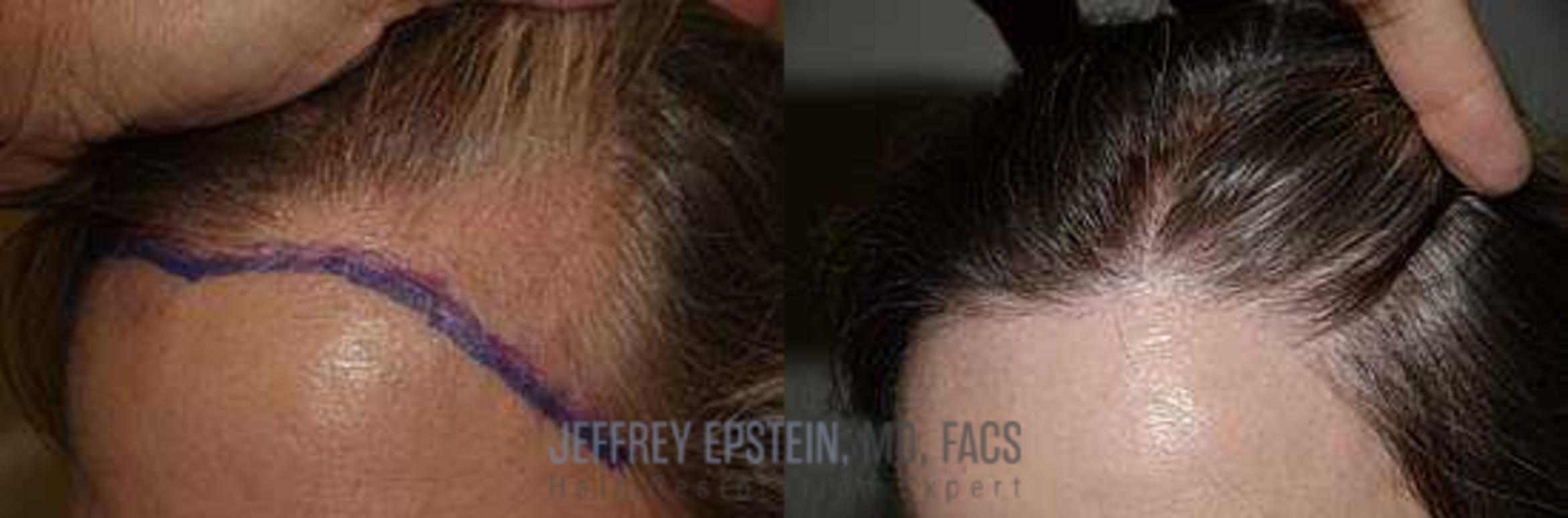 Before & After Hair Transplants For Women Case 184 View 2 View in Miami, FL