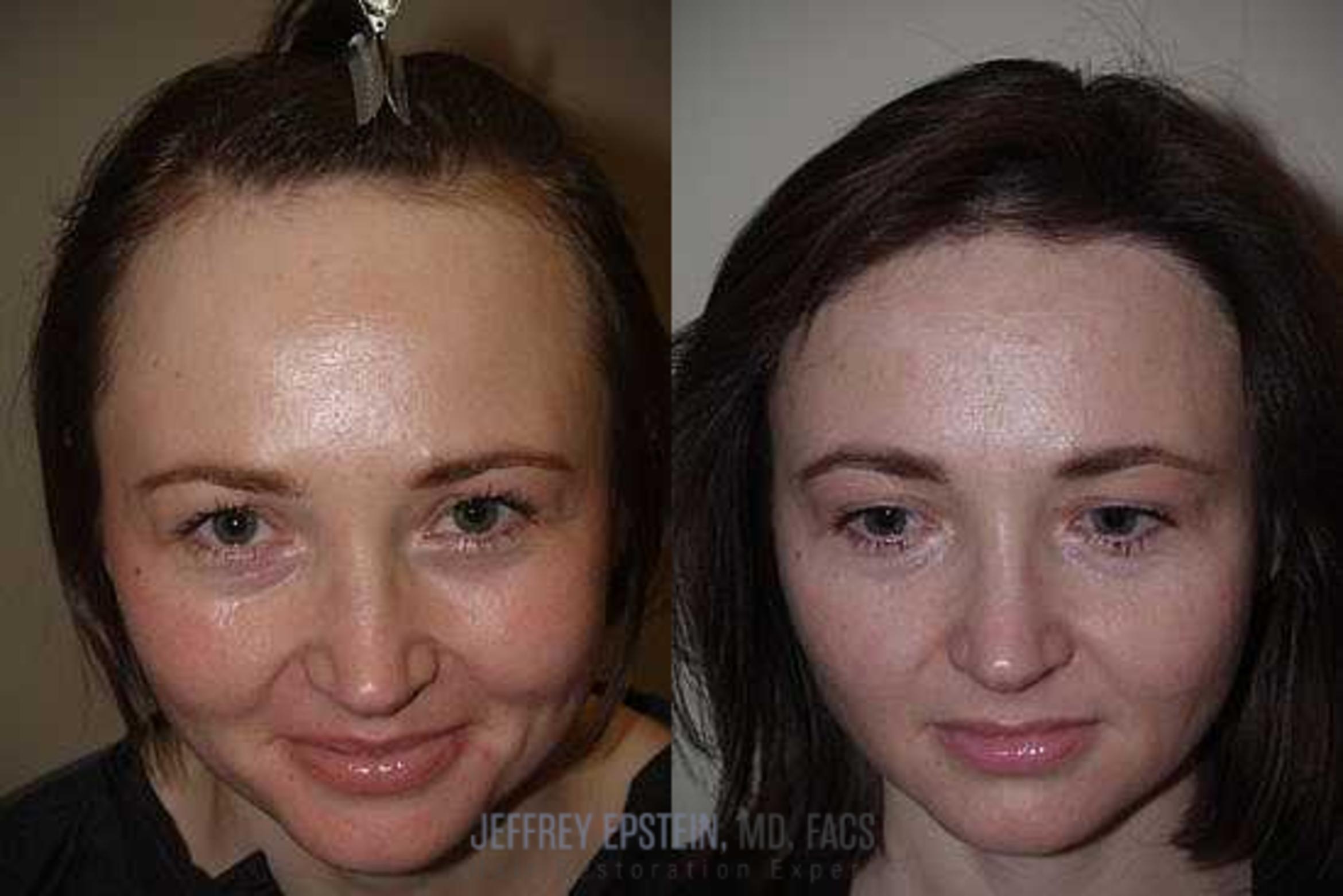 Before & After Hair Transplants For Women Case 187 View 1 View in Miami, FL