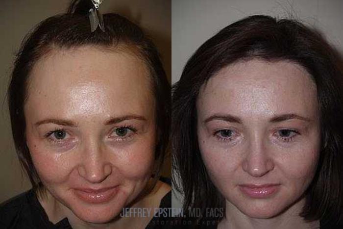 Before & After Hair Transplants For Women Case 187 View 1 View in Miami, FL