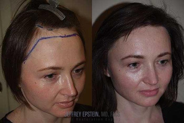 Before & After Hair Transplants For Women Case 187 View 2 View in Miami, FL