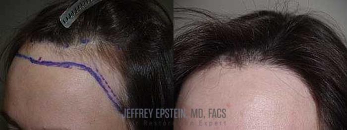 Before & After Hair Transplants For Women Case 187 View 3 View in Miami, FL
