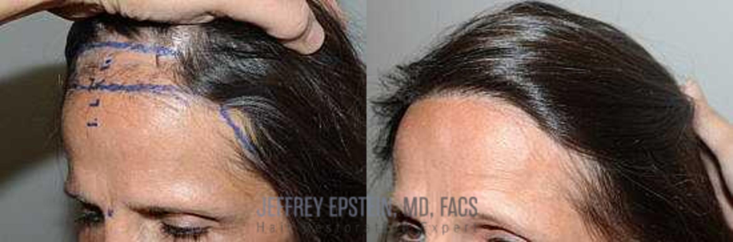 Before & After Hair Transplants For Women Case 188 View 1 View in Miami, FL