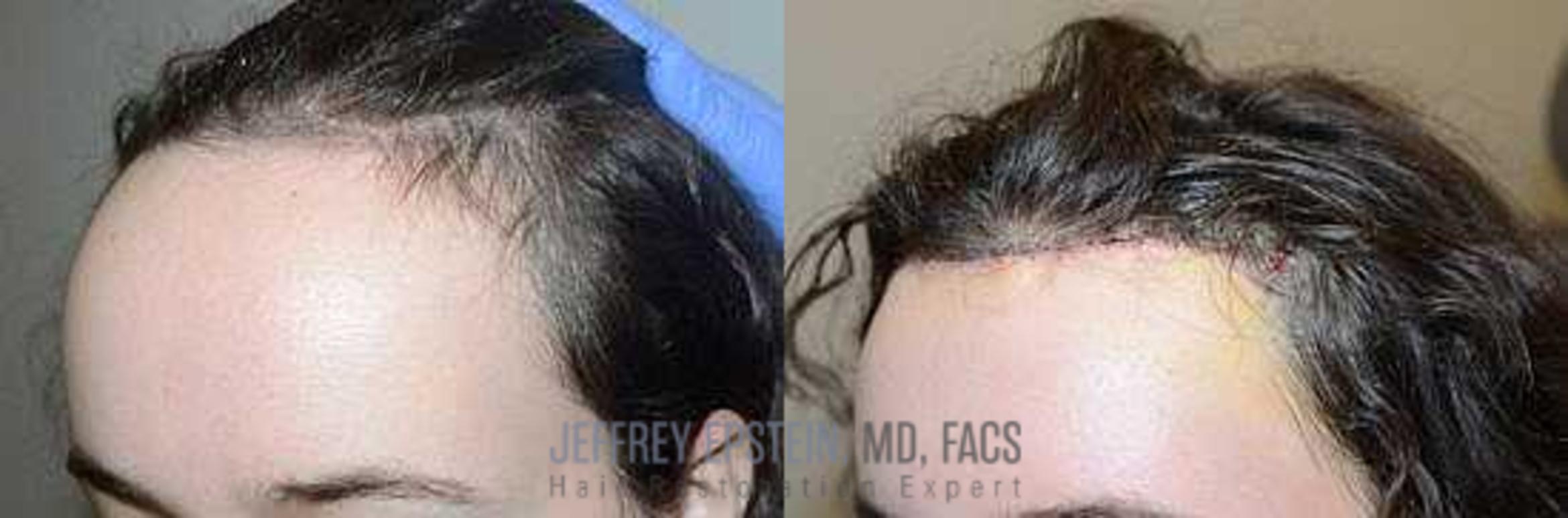 Before & After Hair Transplants For Women Case 189 View 1 View in Miami, FL