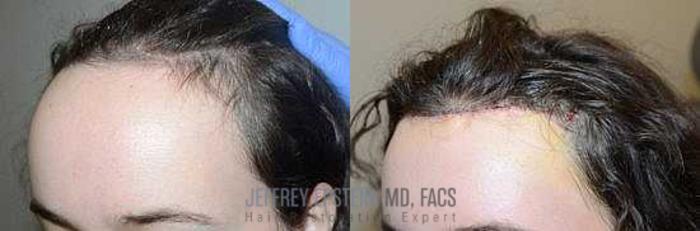 Before & After Hair Transplants For Women Case 189 View 1 View in Miami, FL