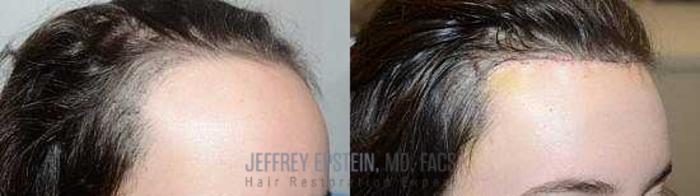 Before & After Hair Transplants For Women Case 189 View 2 View in Miami, FL