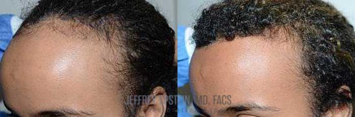 Before & After Hair Transplants For Women Case 190 View 2 View in Miami, FL