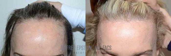 Before & After Hair Transplants For Women Case 191 View 2 View in Miami, FL