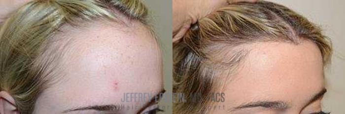Before & After Hair Transplants For Women Case 192 View 3 View in Miami, FL