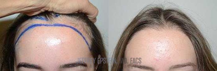 Before & After Hair Transplants For Women Case 193 View 1 View in Miami, FL