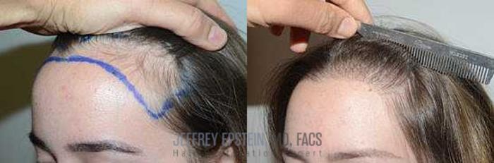 Before & After Hair Transplants For Women Case 193 View 2 View in Miami, FL