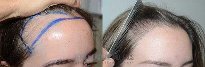 Before & After Hair Transplants For Women Case 193 View 3 View in Miami, FL