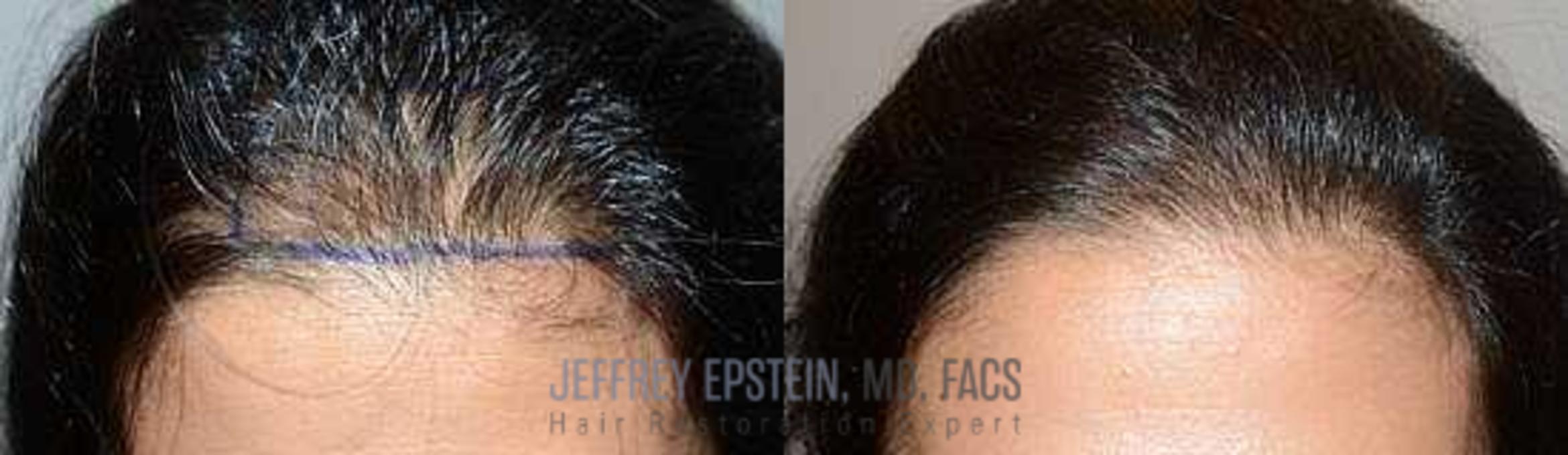 Before & After Hair Transplants For Women Case 194 View 1 View in Miami, FL