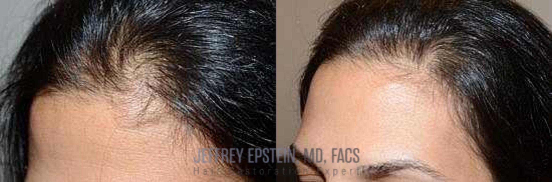 Before & After Hair Transplants For Women Case 194 View 2 View in Miami, FL