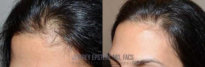 Before & After Hair Transplants For Women Case 194 View 2 View in Miami, FL