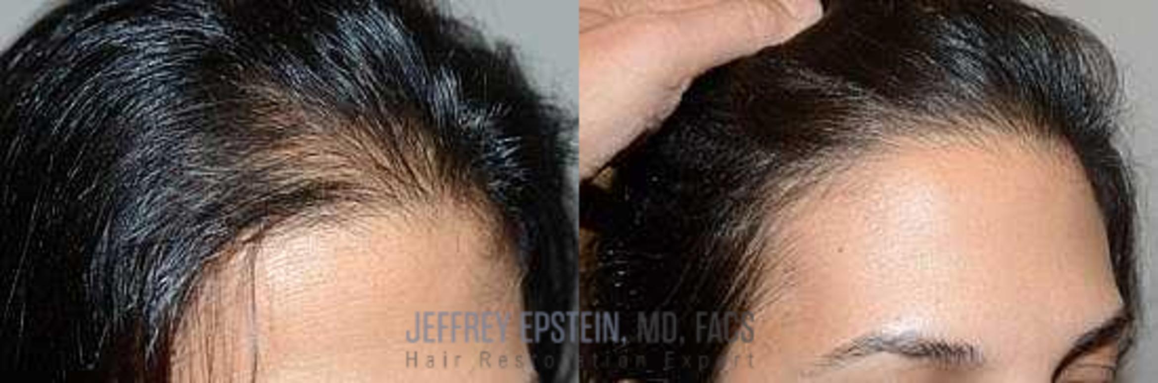 Before & After Hair Transplants For Women Case 194 View 3 View in Miami, FL