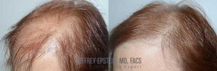 Before & After Hair Transplants For Women Case 197 View 1 View in Miami, FL