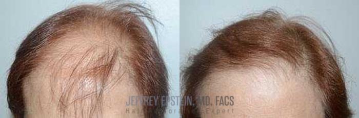 Before & After Hair Transplants For Women Case 197 View 2 View in Miami, FL