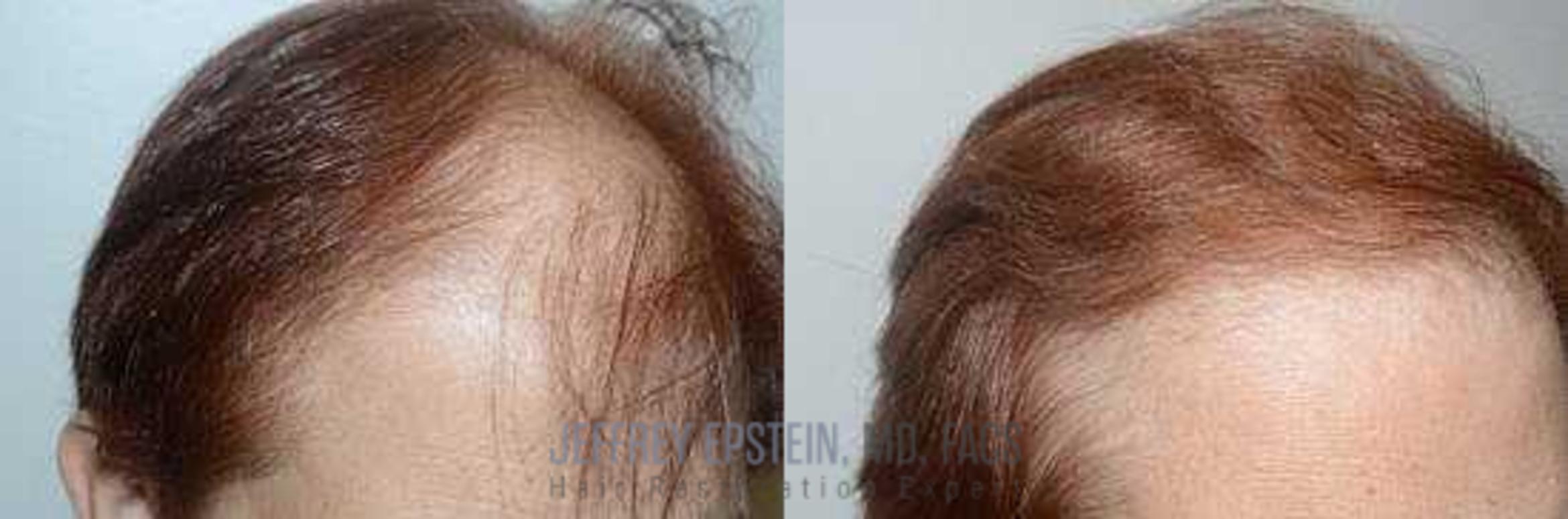 Before & After Hair Transplants For Women Case 197 View 3 View in Miami, FL