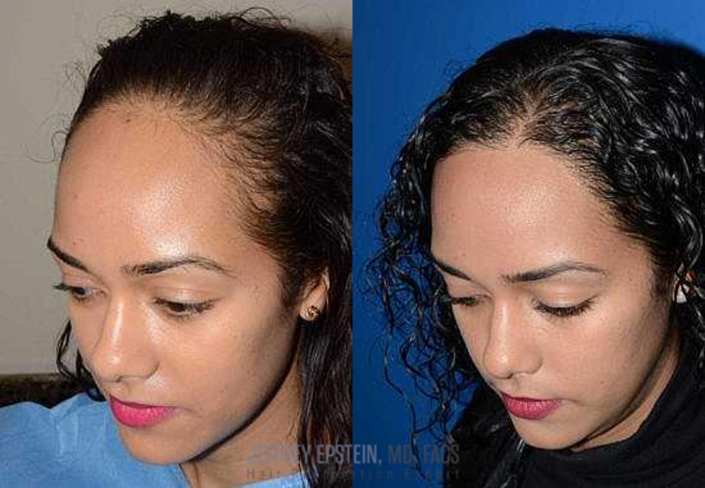 Before & After Hair Transplants For Women Case 198 View 1 View in Miami, FL