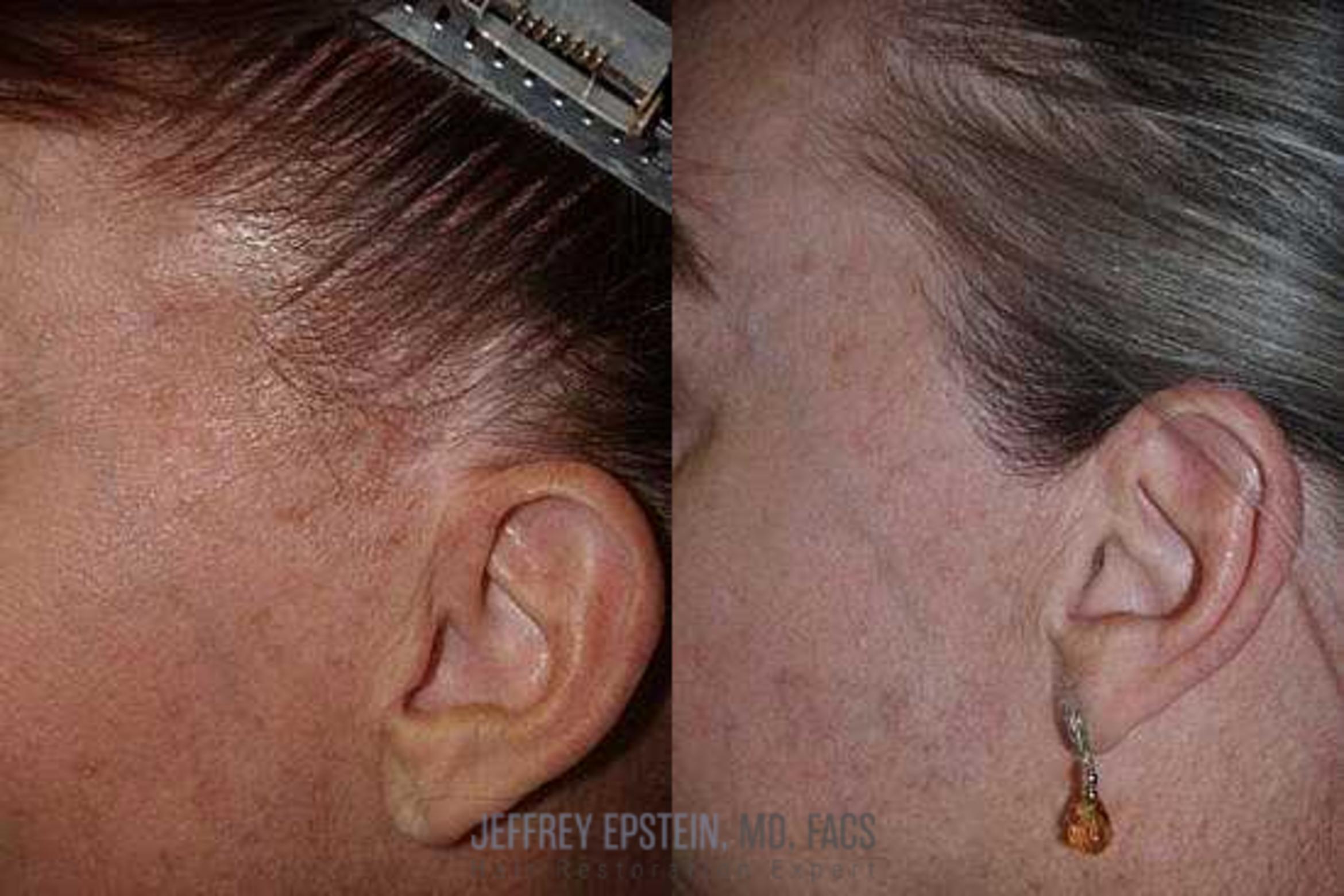 Before & After Hair Transplants For Women Case 199 View 1 View in Miami, FL