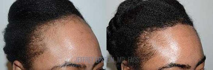 Before & After Hair Transplants For Women Case 200 View 2 View in Miami, FL