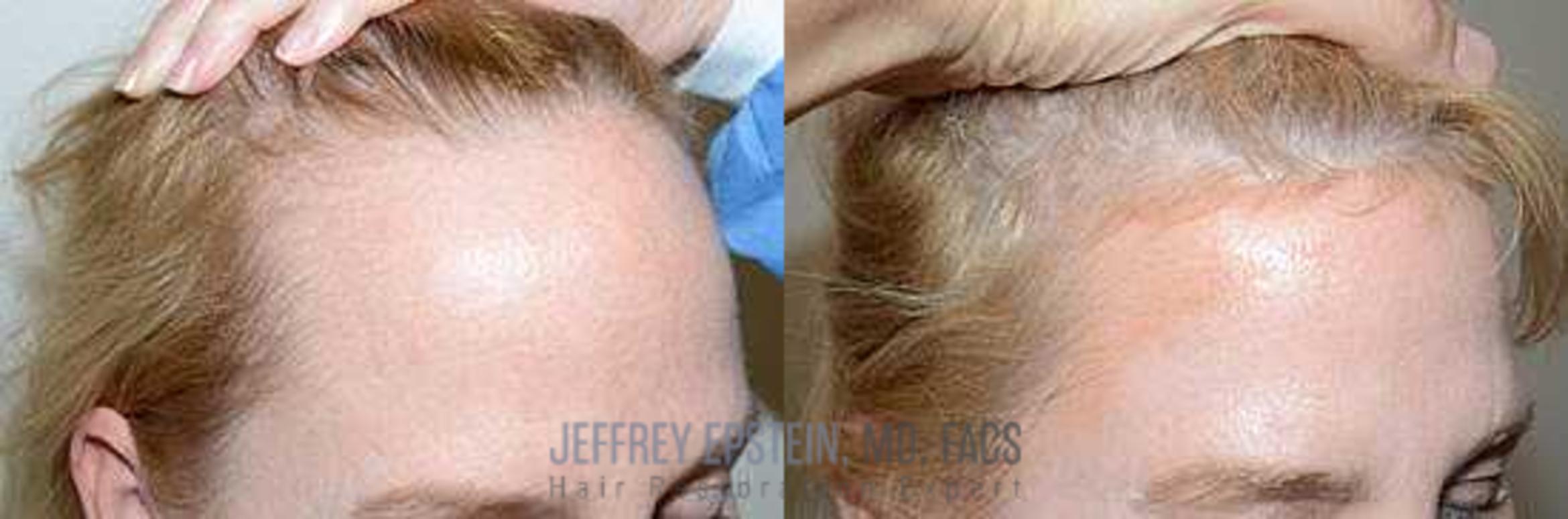 Before & After Hair Transplants For Women Case 201 View 3 View in Miami, FL